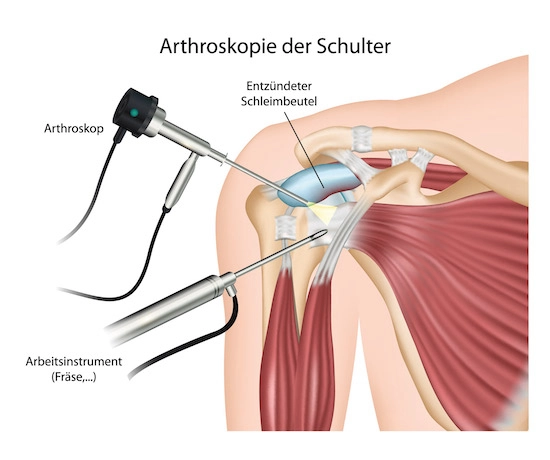 Arthroskopie-Schulter