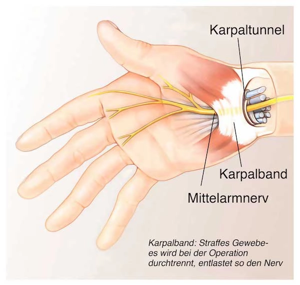 Karpalband-OP-bei-Handschmerzen